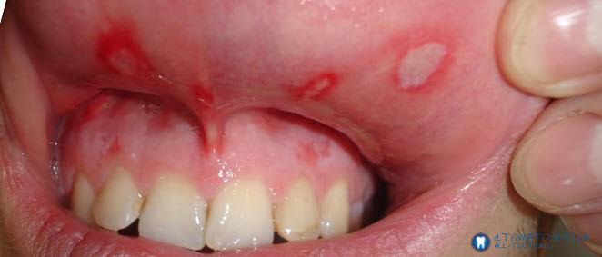 Лечение лейкоплакии губы
